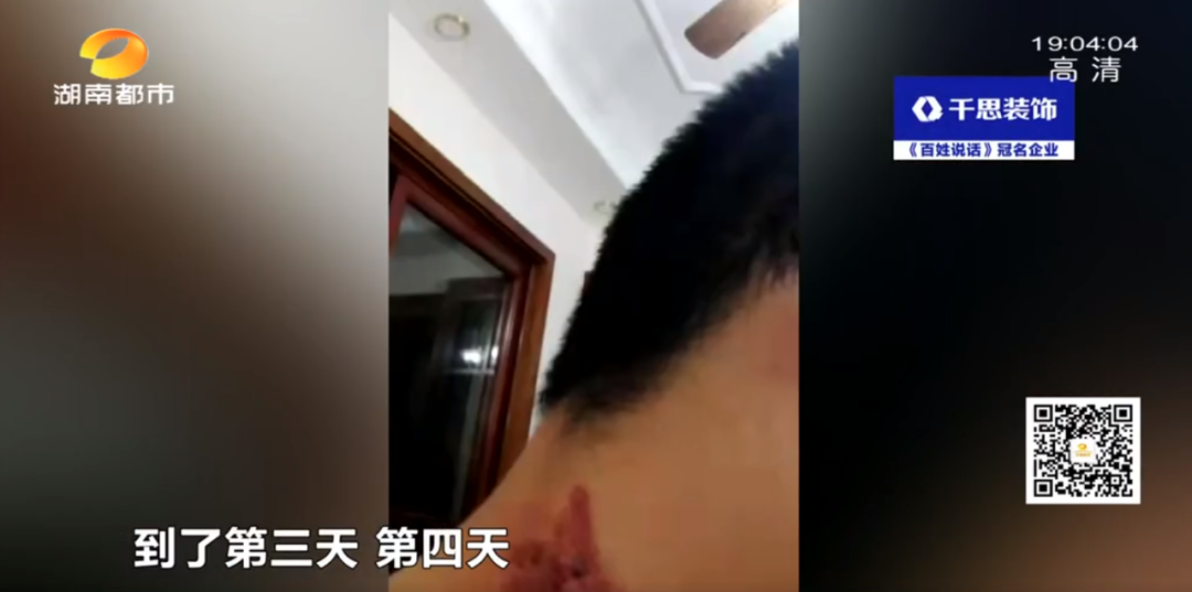 长沙一小区多名业主被“黑虫”毒伤，有医院7天接诊百余例！医生：千万别用手拍