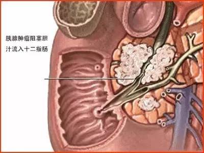 普照医生：胰腺是什么？胰腺炎是怎样引起的？
