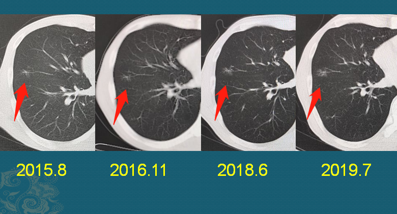 肺纤维灶是什么意思-体检肺纤维灶是什么意思 - 114知识网