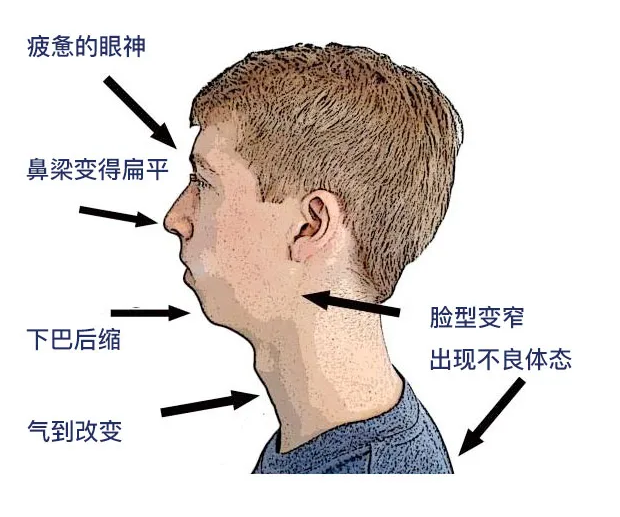 舌头摆放位置不对,影响脸型