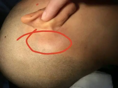 中耳炎胆脂瘤取出图片(耳中藏) - 赤虎壹号