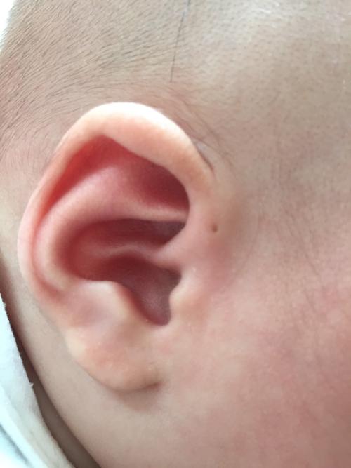 婴儿耳垂有褶皱图片图片