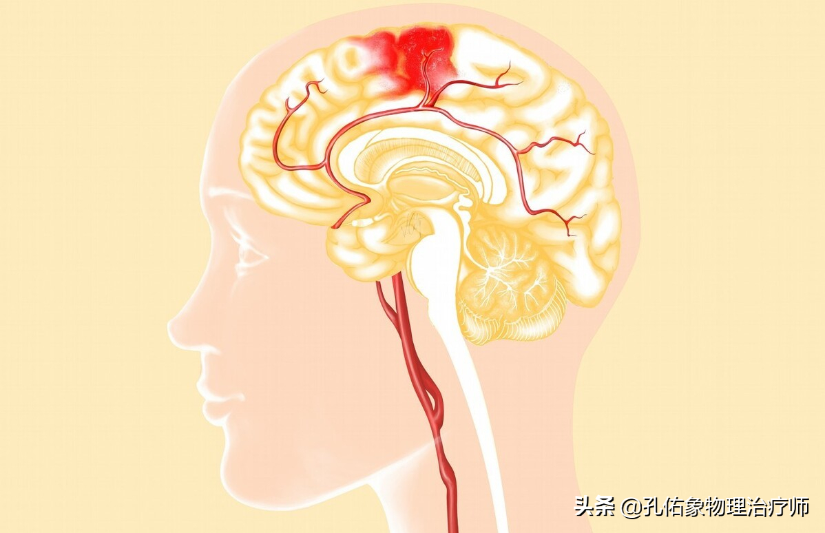 为何如此多的人发生脑出血？要如何正确应对？一文详细告知您