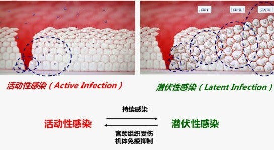 HPV检测预防宫颈癌的方法与检查流程