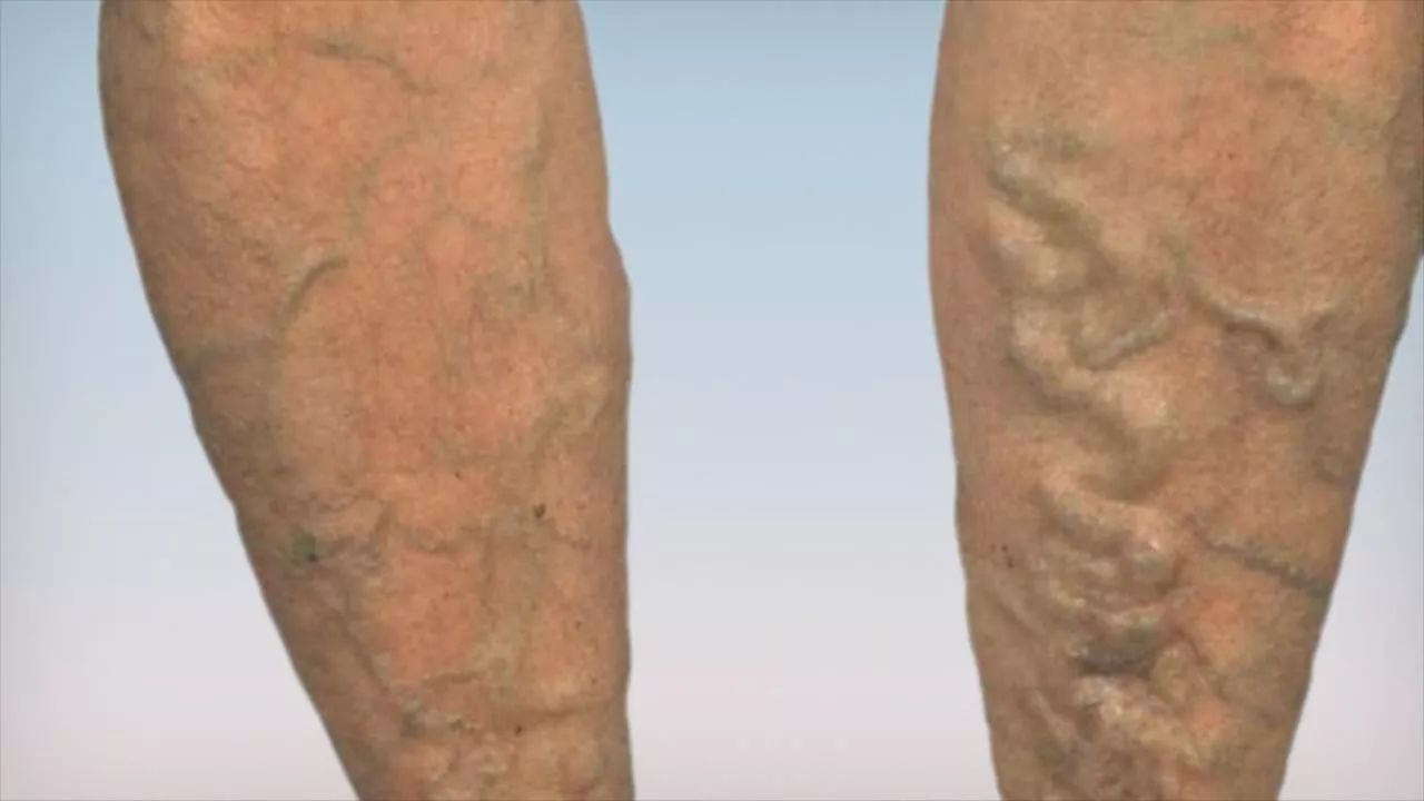 人与血管同寿，血管老化，身体先知，这些症状别忽视