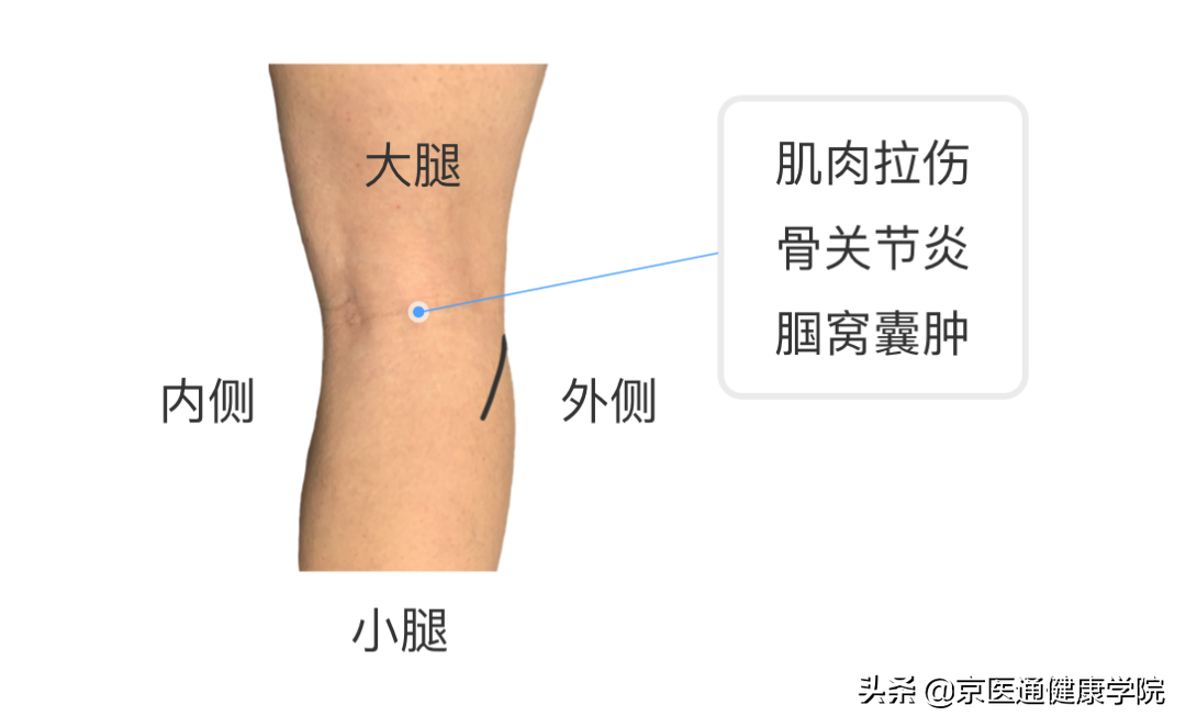 膝盖疼是什么病？积水潭专家教你1个动作判断