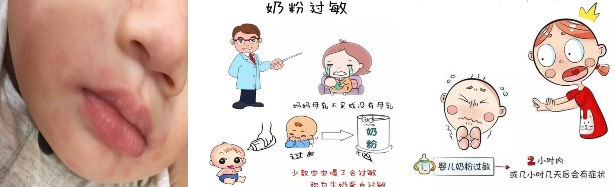 宝宝奶粉过敏了！怎么破？