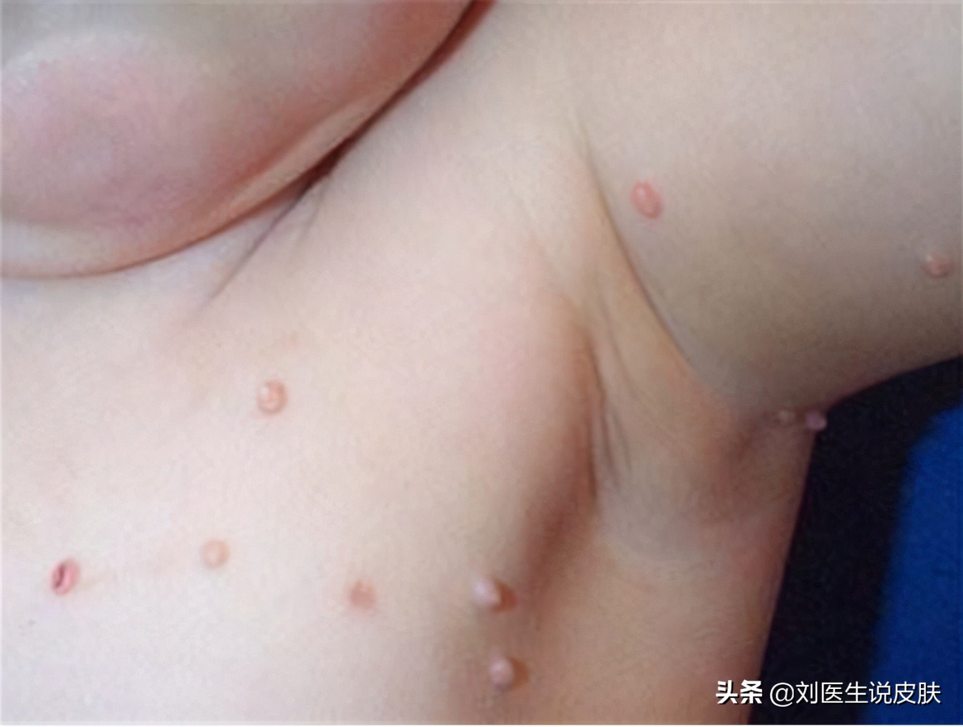 丝状疣是怎么引起的(皮肤长小好看的小说疙瘩)