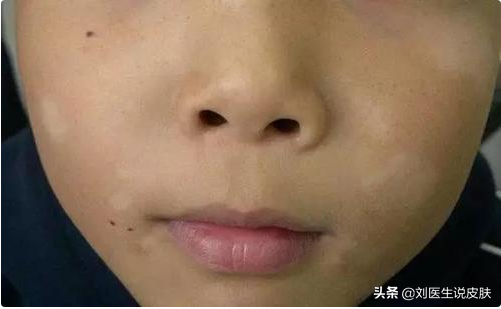 20岁女子患白癜风后，牢记医生说的这3个原则，然后白斑就没了