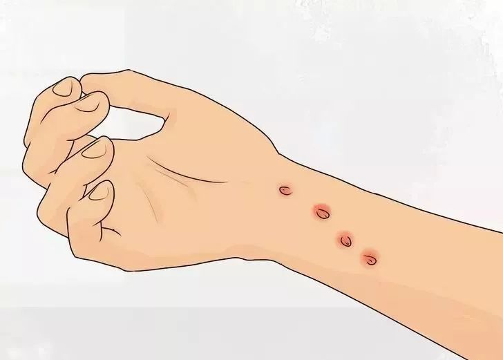 跳蚤咬的脓包怎么处理