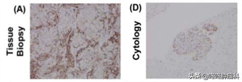 PD-L1检测里的门道：不同的检测标准，最终结果可能完全不同