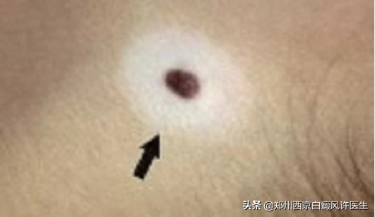 新乡晕痣型白癜风患者，没有及时治疗导致白斑扩散，现在后悔晚了