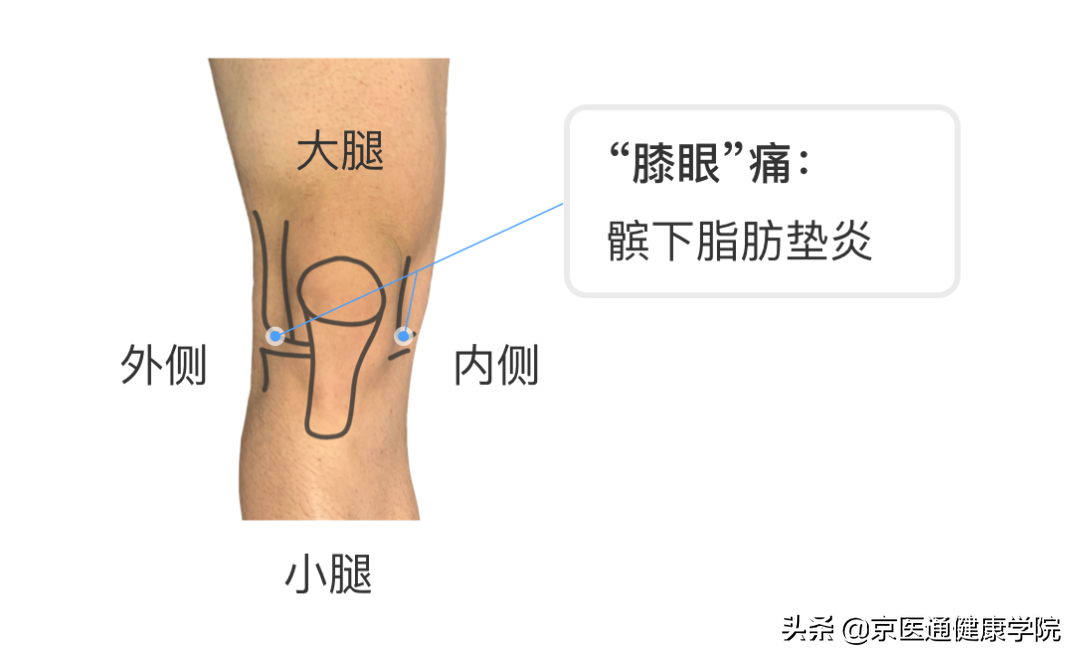 膝盖疼是什么病？积水潭专家教你1个动作判断