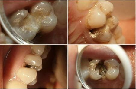 牙齿莫名变黑是为什么？牙上的小黑点该怎么去除？看看牙医怎么说