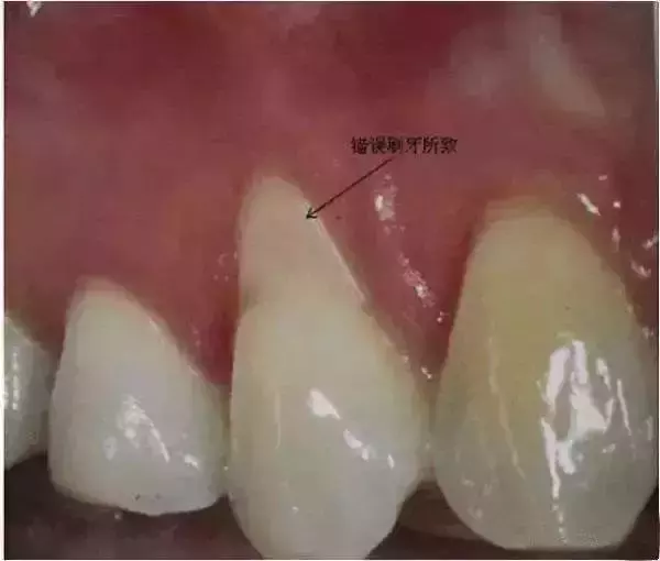 医生,我的牙龈萎缩了,能再恢复吗?