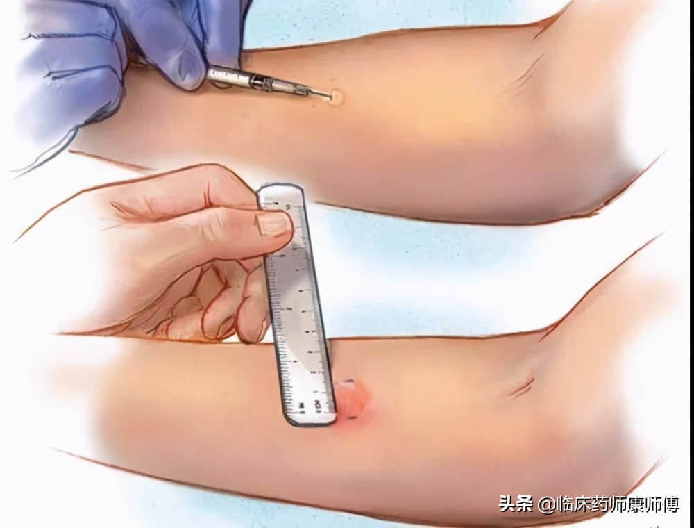 抗生素皮试结果判断及需做皮试人群指南