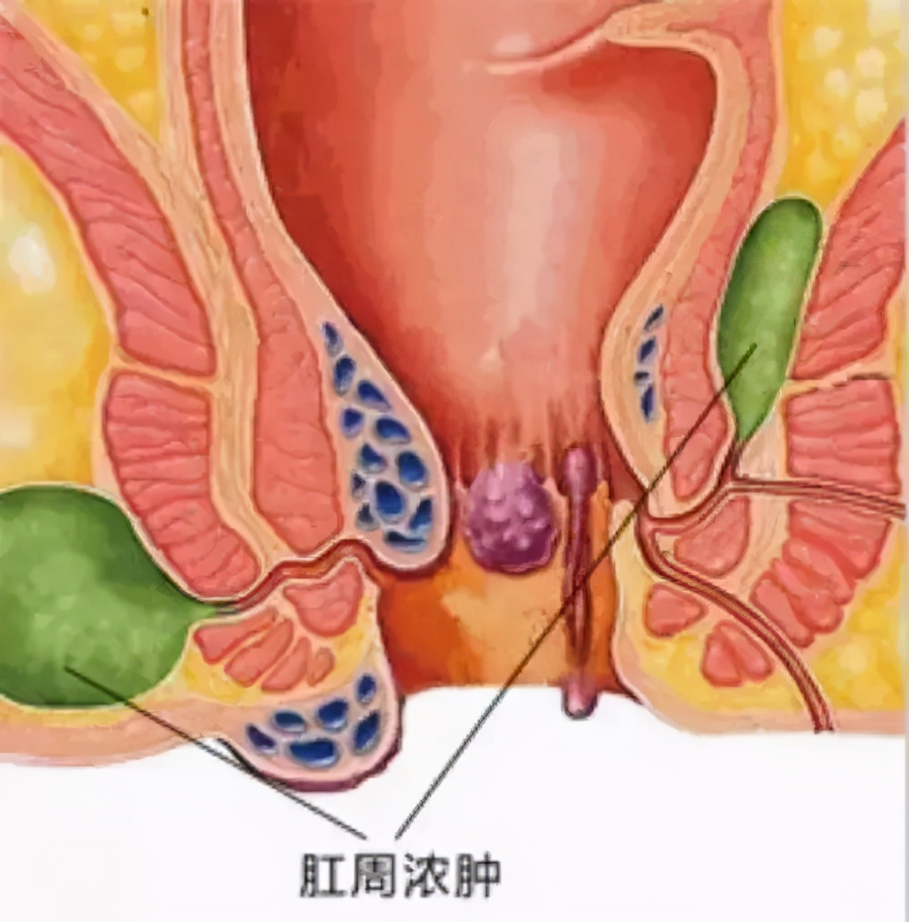 婴儿肛瘘的症状图片（当宝宝无端哭闹）