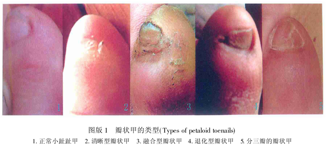 自己的小脚趾的指甲是长成两瓣的,这种现象在医学上被称为"瓣状甲"