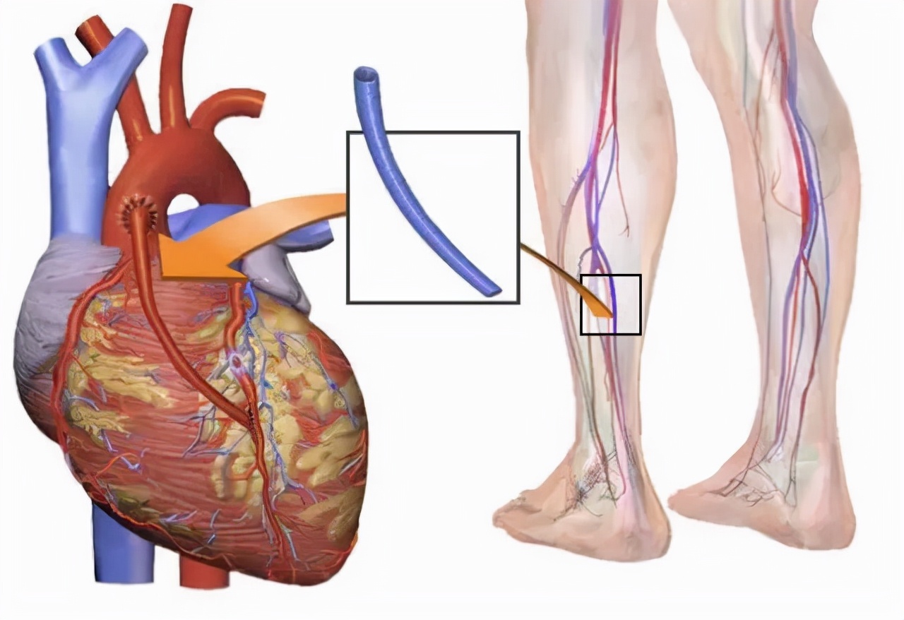 当&ldquo;心脏病&rdquo;撞上&ldquo;疝&rdquo;