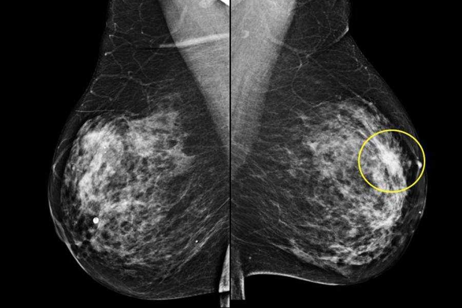 乳腺疾病常用的检查方法和治疗手段有哪些？看这篇文章你就明白了