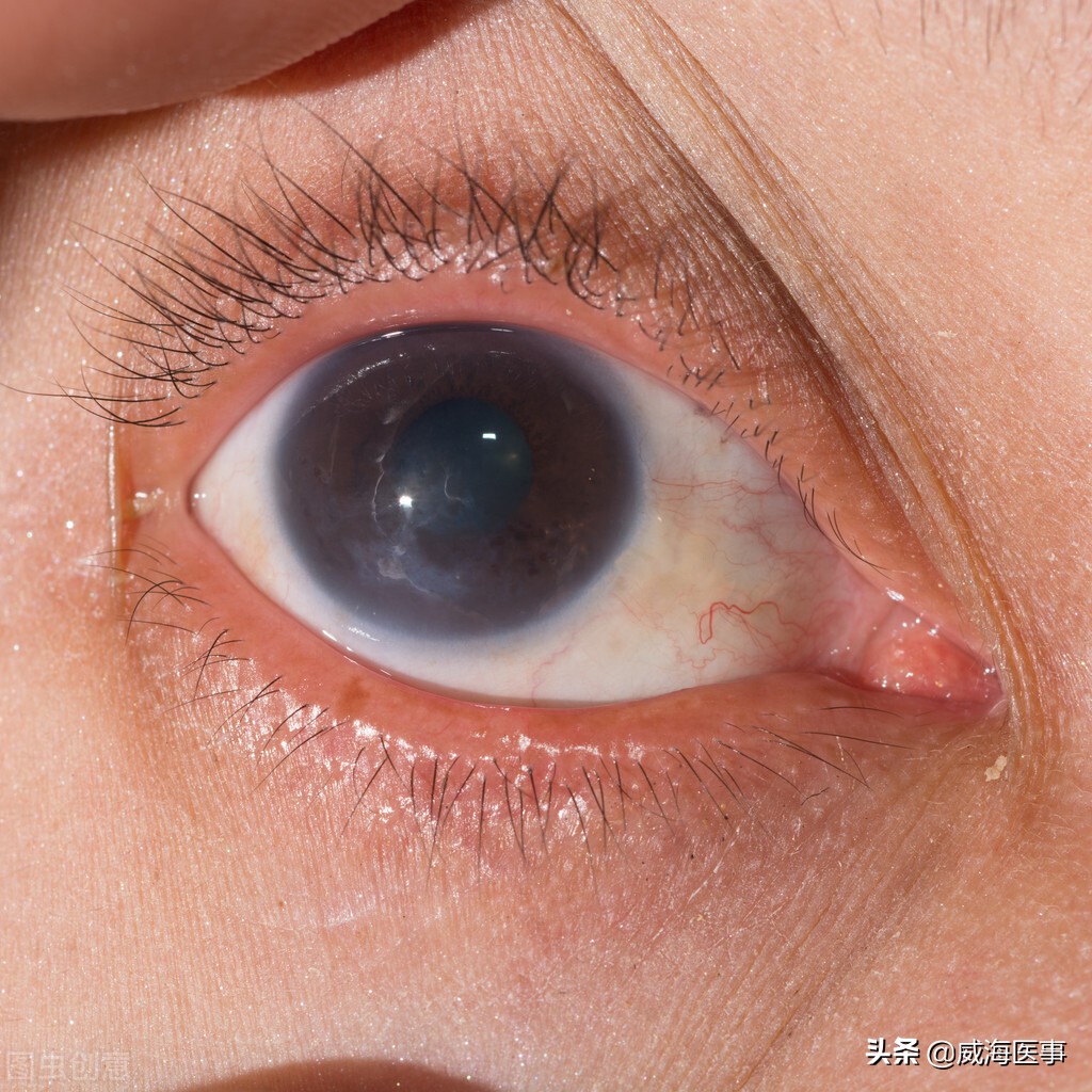 儿童角膜炎的症状图片图片