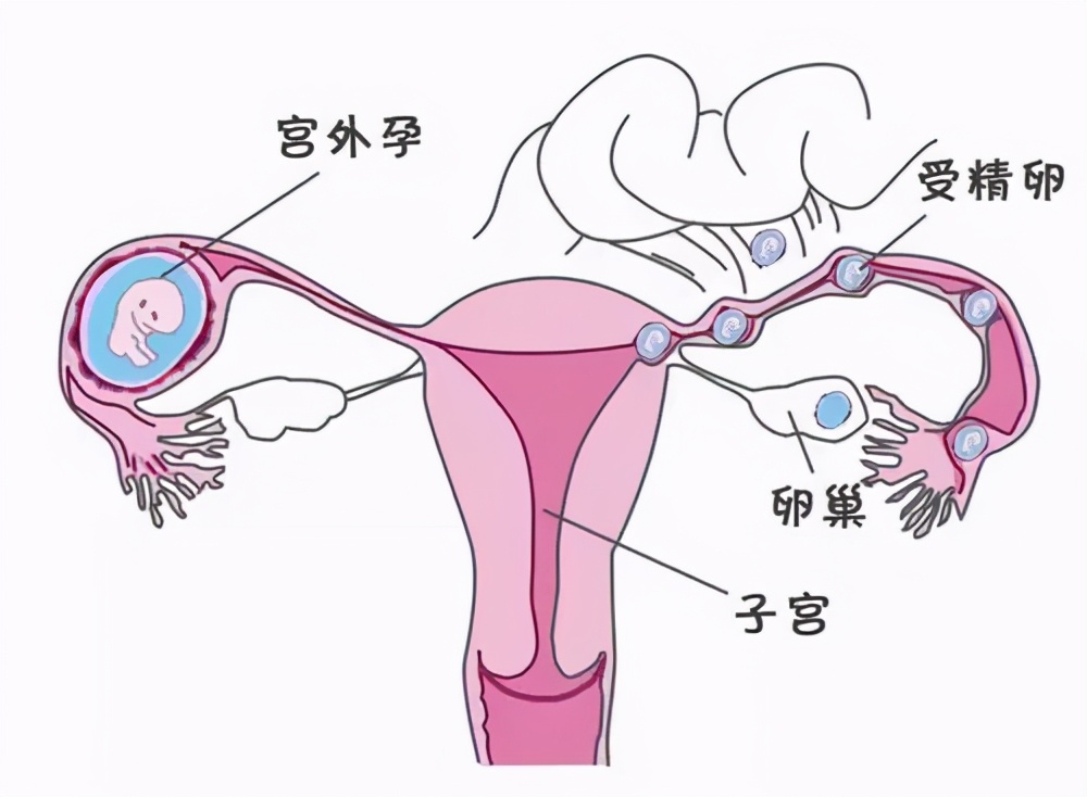 输卵管堵塞怎么治疗？你想知道的问题这儿都有答案1