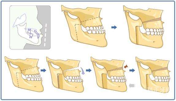 "地包天"不仅影响咬合还影响面容，该怎么矫正？听听牙医的建议