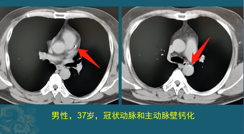 一瓶降压药值多少钱？3千到7万，这不是玩笑