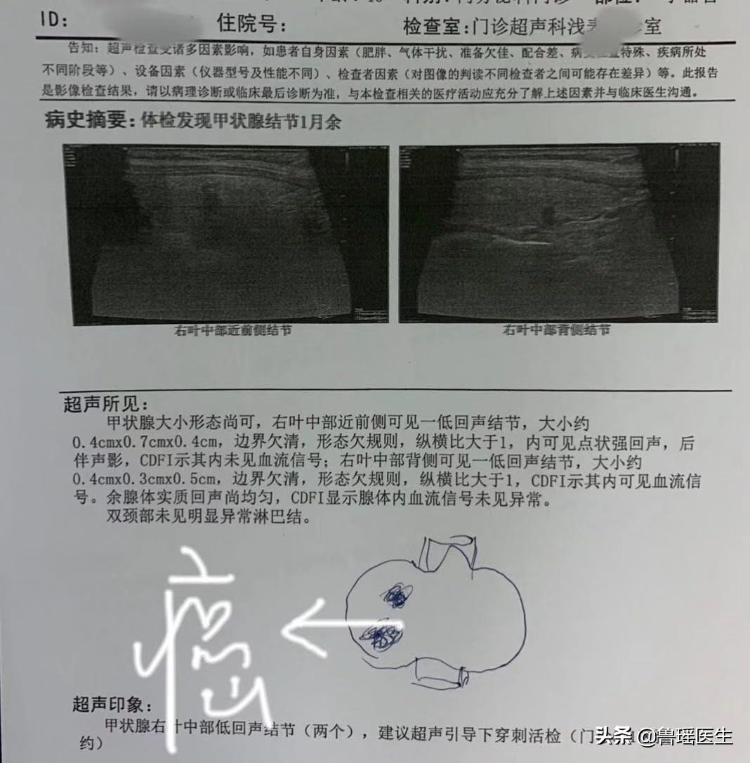 不同医院做的甲状腺B超结果会有差异吗？