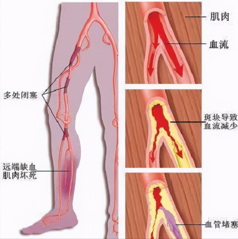 动脉粥样硬化闭塞怎么办？专科医生告诉您这样治疗效果好