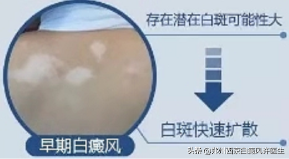 新乡晕痣型白癜风患者，没有及时治疗导致白斑扩散，现在后悔晚了
