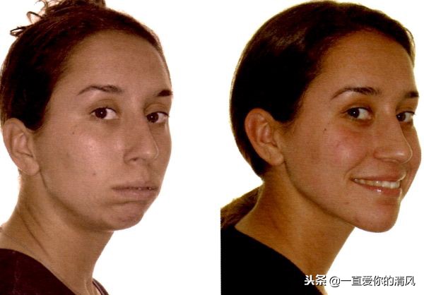 高挺的鼻子,但是一张嘴就能"毁掉"一张脸,严重的凸嘴和龅牙十分影响