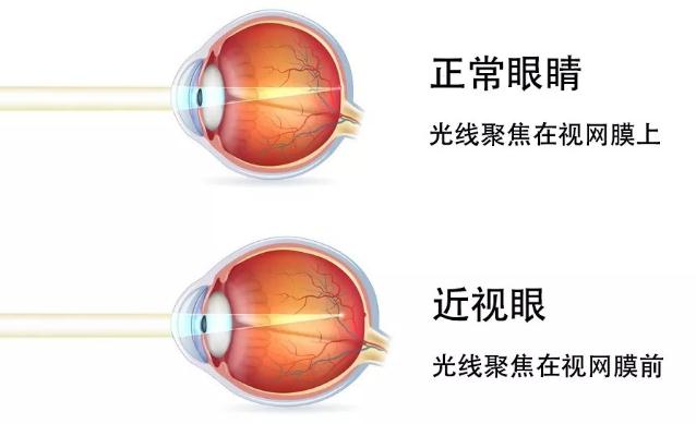 "近视眼镜"已经发明237年了,为何我们还无法摆脱它