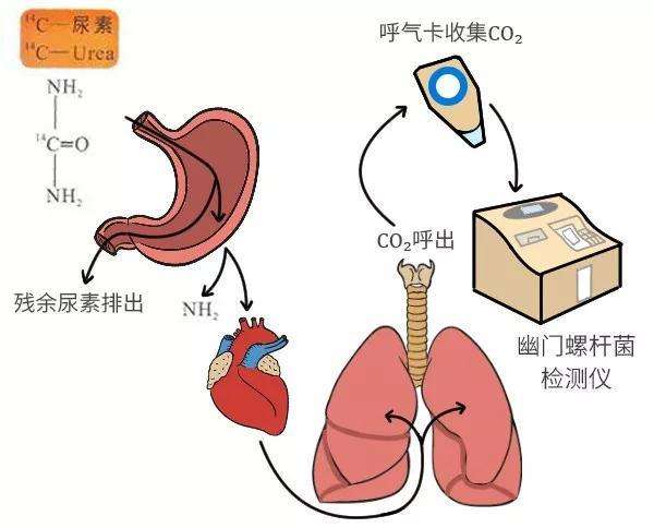 如何知道是否感染了幽门螺杆菌？来看看医生介绍的3类检查法