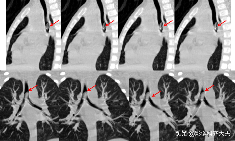 如何应用CT诊断小儿气管异物