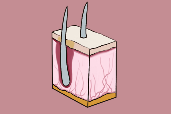 脖子和腋下长出的小肉粒，不痛也不痒，是啥东西？该怎么处理？
