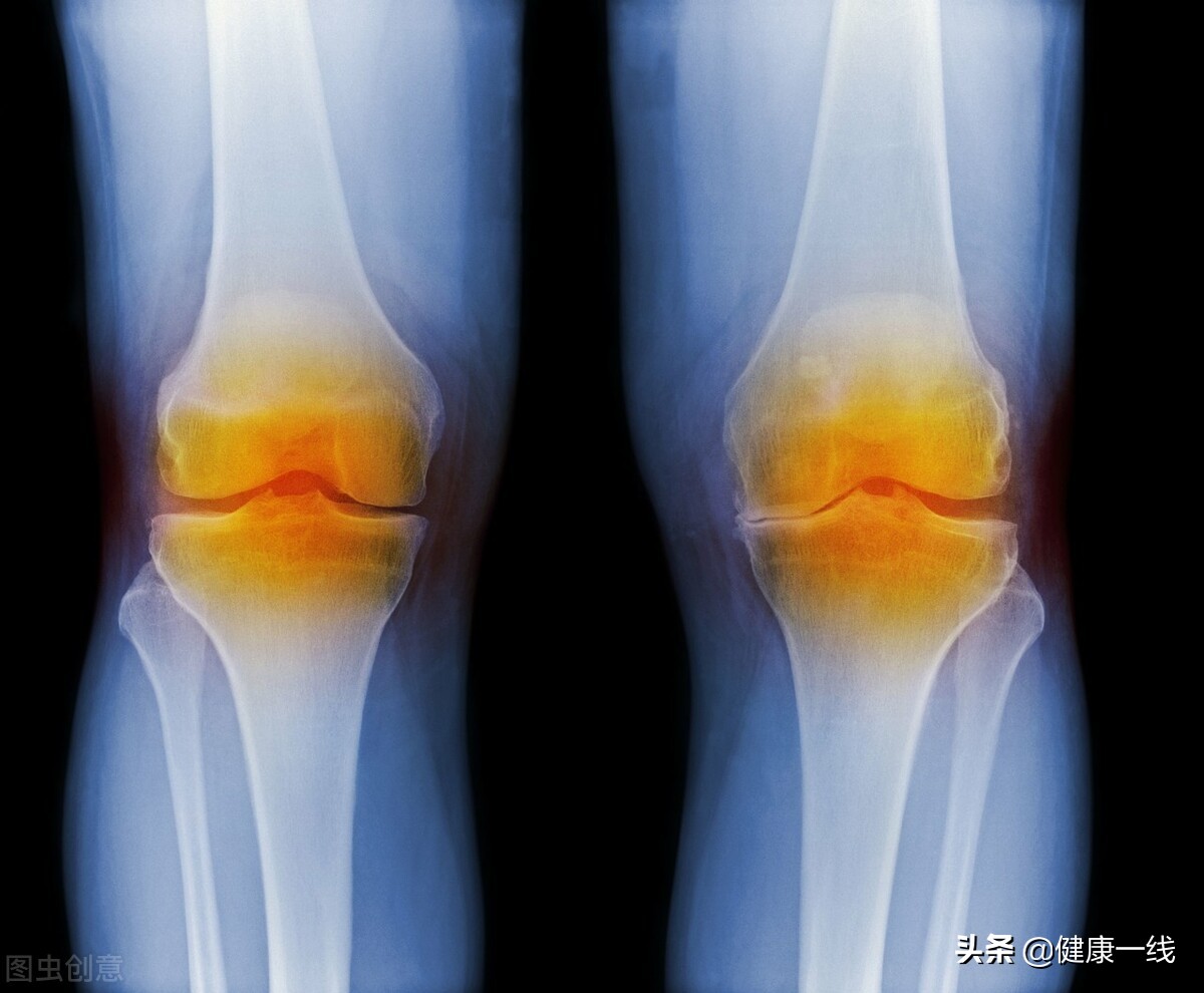骨關節炎的“炎症”從何而來？ 如何正確消炎止痛？