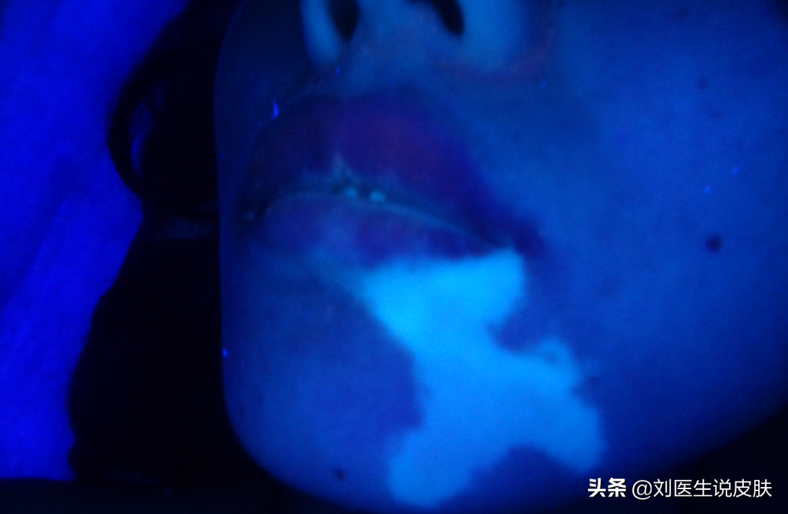 20岁女子患白癜风后，牢记医生说的这3个原则，然后白斑就没了