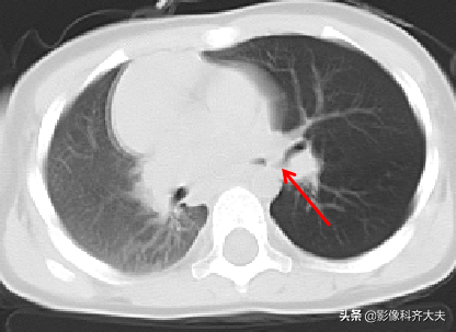 如何应用CT诊断小儿气管异物