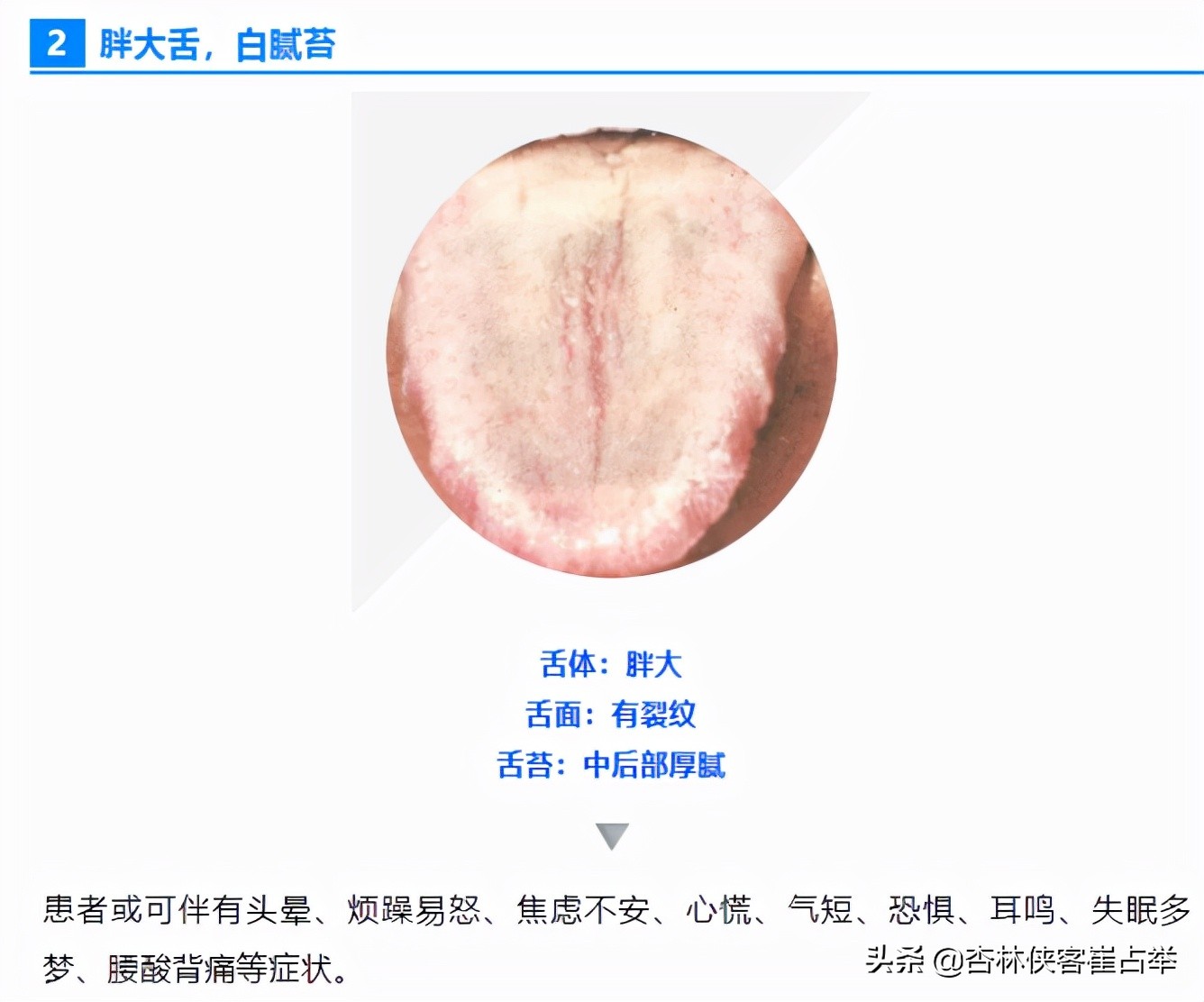 如何通过舌头，分辨心脑血管疾病、中风前兆？教你一招，快速辨别