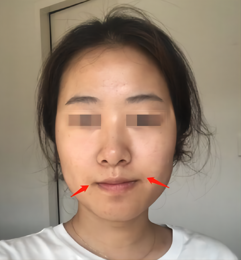 面部不对称的脸应该如何改善？