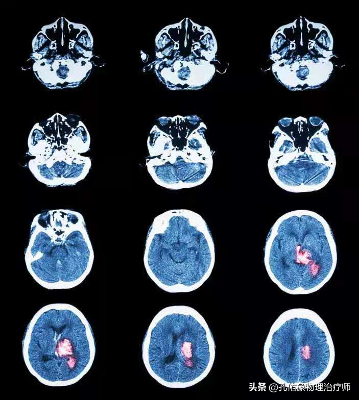 为何如此多的人发生脑出血？要如何正确应对？一文详细告知您