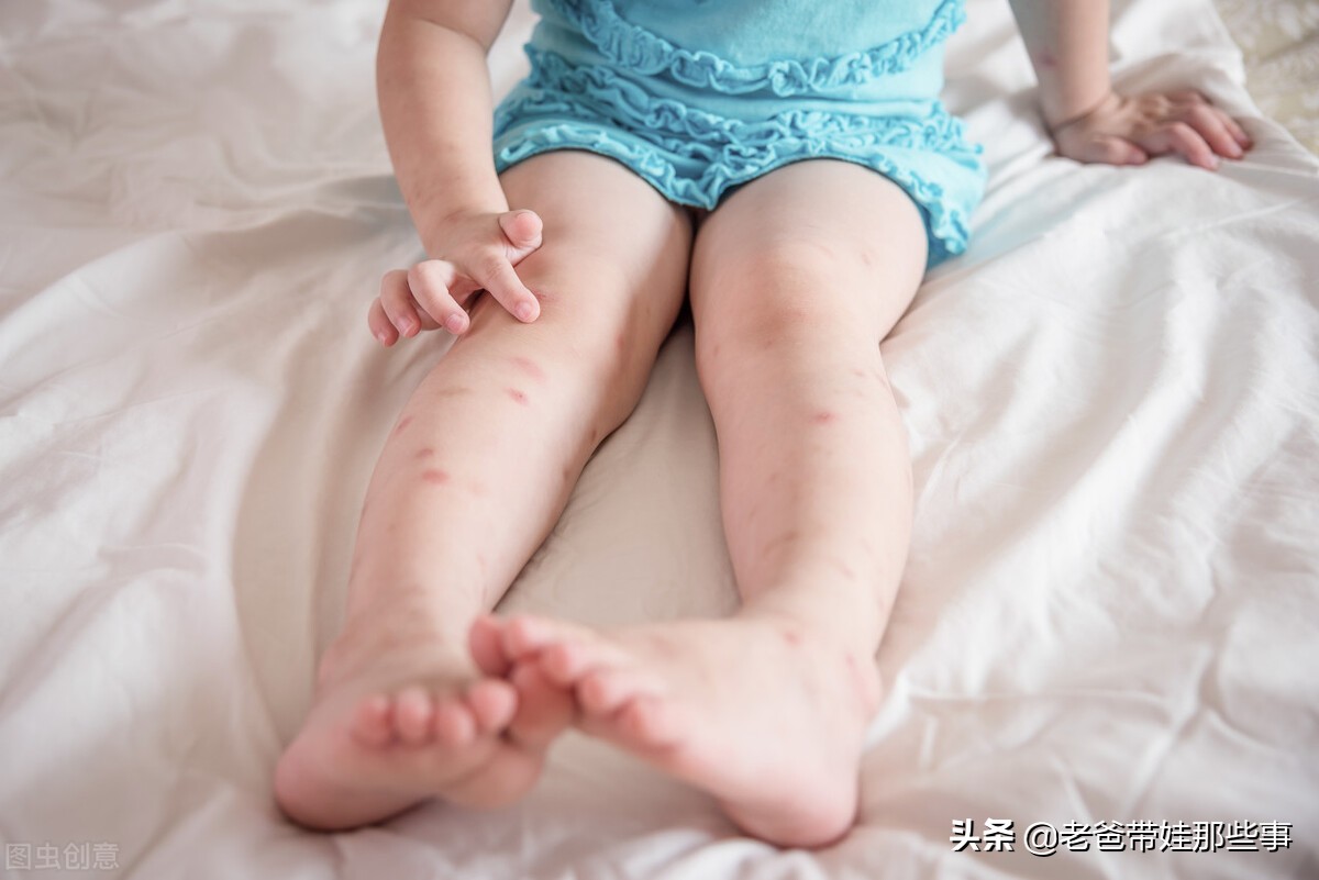 孩子容易被蚊虫叮咬，别乱用花露水！教你驱蚊止痒的正确方法
