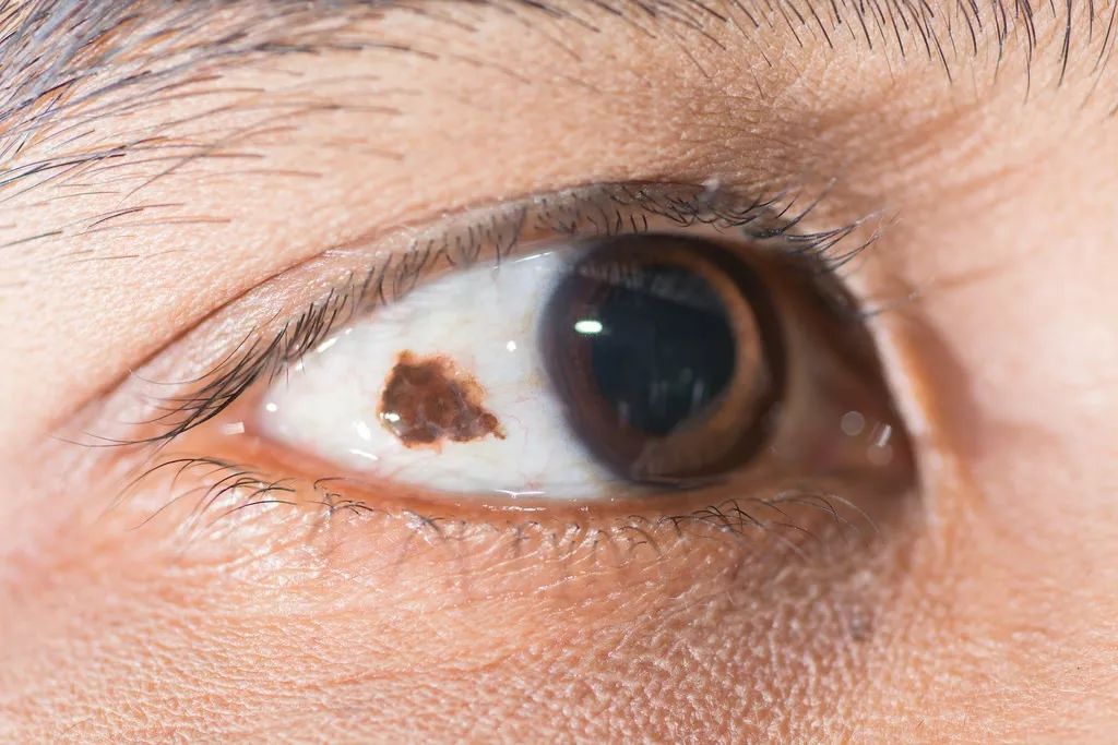 宝宝眼白有黑斑图片(孩子眼白有) - 赤虎壹号