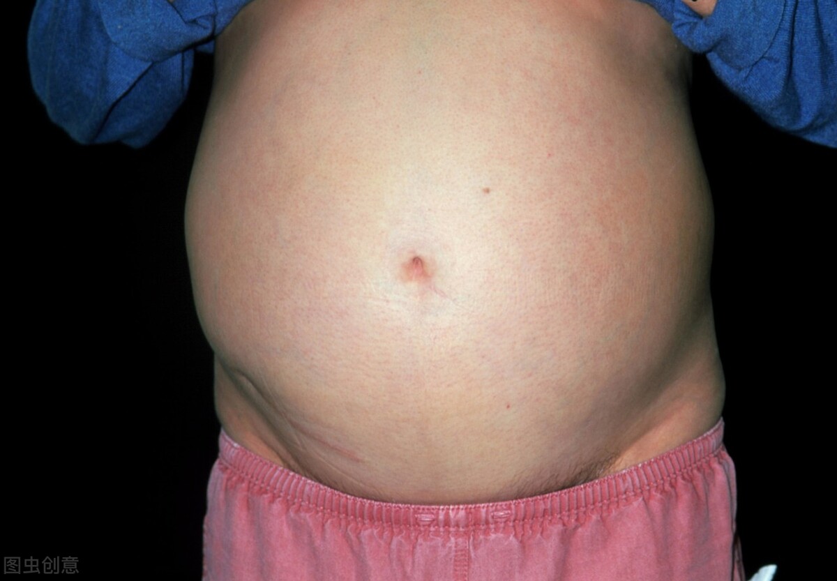 “腹”水难收？肝硬化腹水治疗宝典