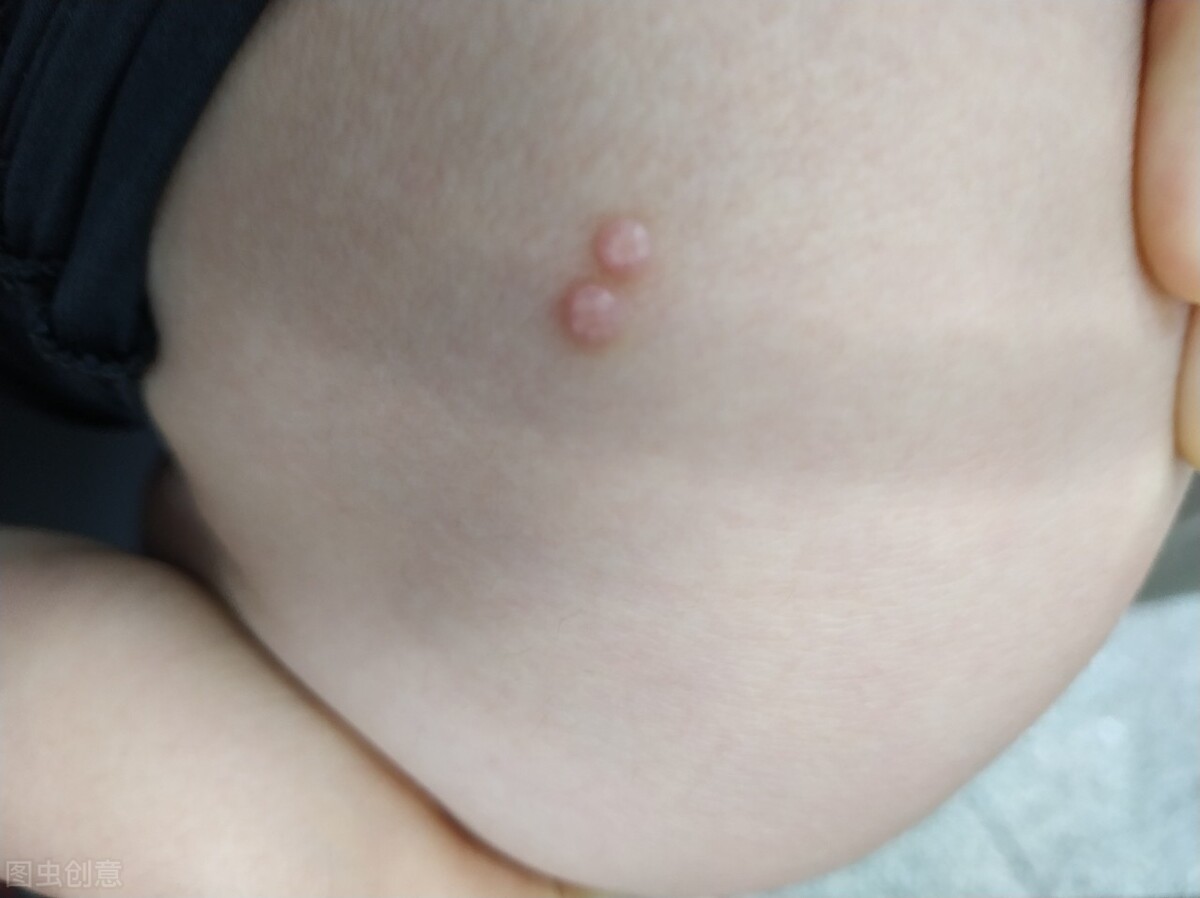 无论男女：身上这1处长出“肉疙瘩”，不要随便“抠”，快去查HPV