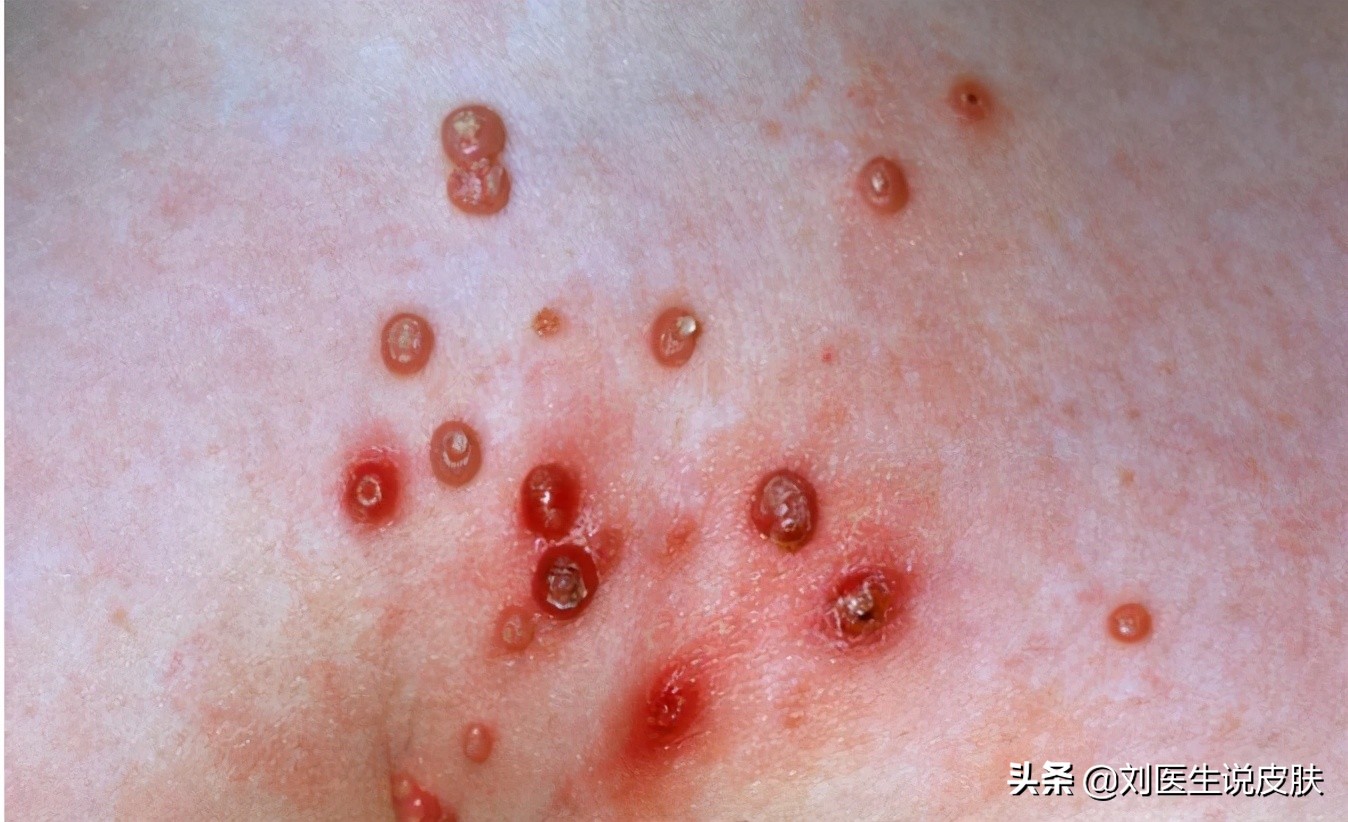 丝状疣是怎么引起的(皮肤长小肉疙瘩)-第2张图片-51乐学网