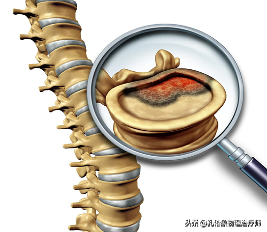 腰臀部疼或下肢麻木，是腰椎间盘突出吗？9种疾病需鉴别