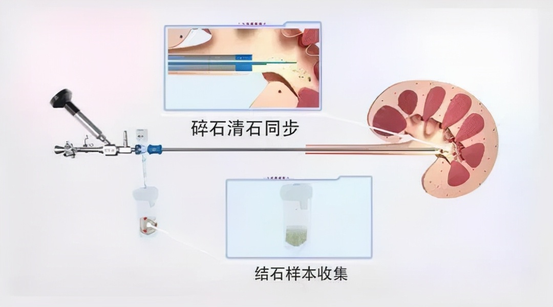 不开刀、不“打洞”！搞定肾结石，其实还可以这样做