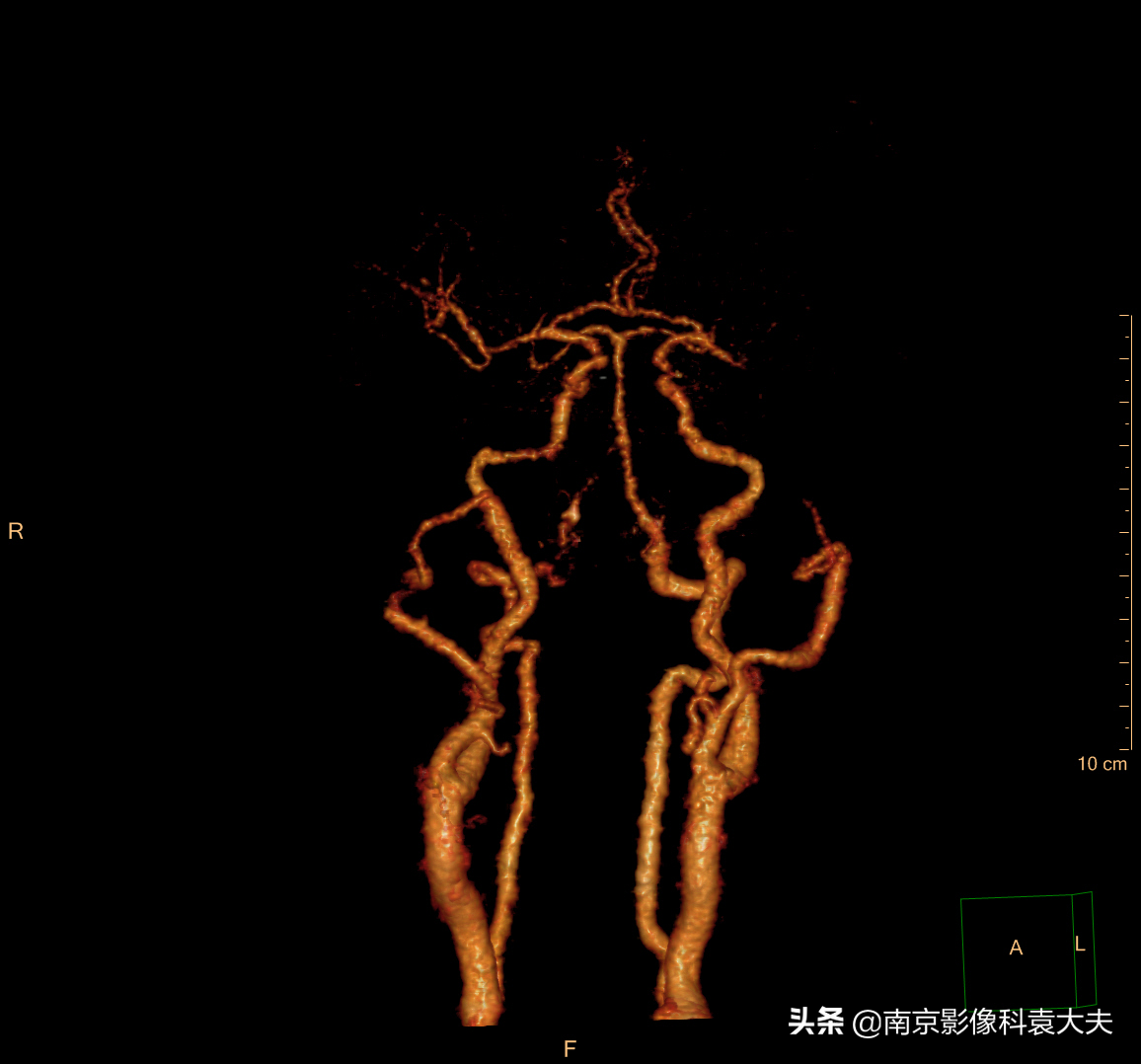 中国脑血管病影像指导手册解读（19年5月版）之急性缺血卒中评估